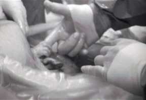 Ծնվելուց  վայրկյաններ առաջ երեխան բռնել է բժշկի ձեռքը