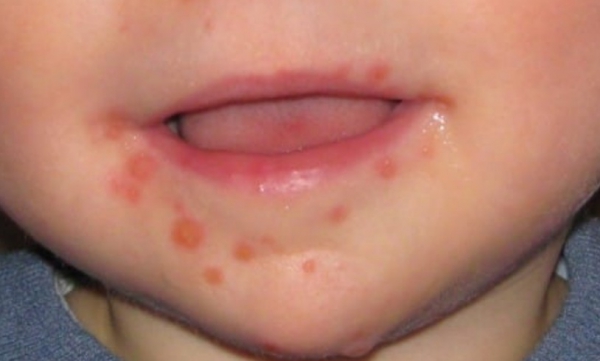 Զգուշացե՛ք, նոր վիրուսի համաճարակ