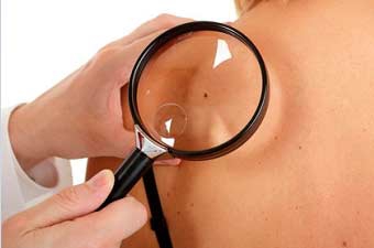 Ուշադրություն դարձրե՛ք խալերին.Բժիշկներն ահազանգում են